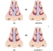 什么因素影响矫正鼻中隔偏曲的价格？要多少钱？