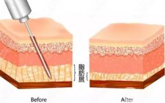 水动力吸脂价格的影响因素有哪些？有什么副作用？