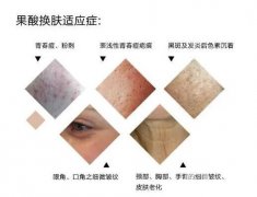 果酸换肤适合哪些人？不适合哪些人？