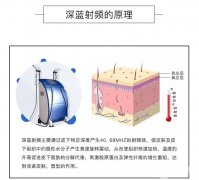 深蓝射频除皱有什么优点？哪些因素决定深蓝射频除皱的价格