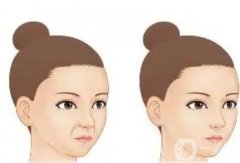 哪些因素影响玻尿酸填充法令纹的价格？法令纹填充后需要注意什么？