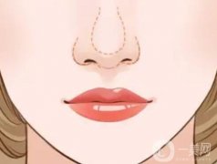 什么样的假体垫鼻尖会穿透鼻尖？有哪些注意事项？