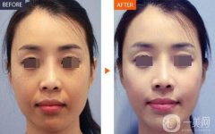 做自体脂肪填充鼻唇沟调节果怎么样?果保持时间多久?