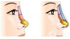 鞍鼻整形贵吗，价格是多少?