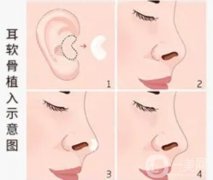 耳软骨垫鼻尖有什么副作用和后遗症？