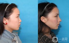 做自体肋软骨隆鼻调节果怎么样?果保持时间多久?