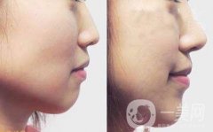 做驼峰鼻矫正调节果怎么样?果保持时间多久?
