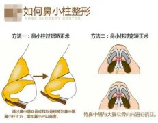 玻尿酸可以注射鼻小柱吗？鼻小柱延长有哪些常用方法