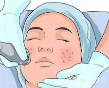 彩光嫩肤可以去除痘印吗？如何护理？