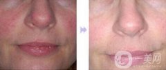 做皮肤磨削术调节酒糟鼻调节果怎么样?果保持时间多久?