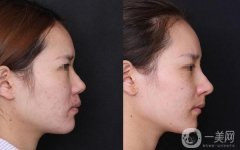 做隆鼻调节果怎么样?果保持时间多久?