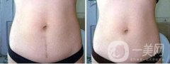 做剖腹产疤痕修复调节果怎么样?果保持时间多久?