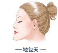 地包天有哪些手术方法？