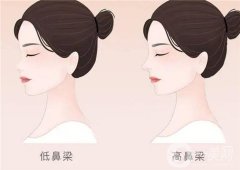 垫鼻梁前有哪些注意事项？近视手术后多久可以垫鼻梁？