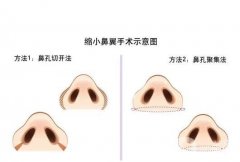 鼻翼缩小有哪些手术方法？手术前应该注意什么？