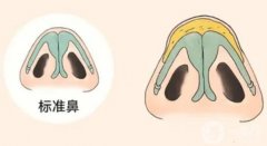 鼻头缩小手术的优点和缺点是什么？