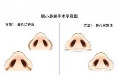鼻翼缩小有什么后遗症吗？后遗症是什么？