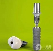 不同瑞士种植体iti有哪些优缺点？