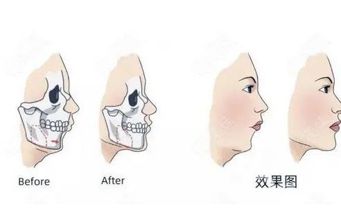 上海华美李志海削骨【下颌角整形】真人反馈来辣