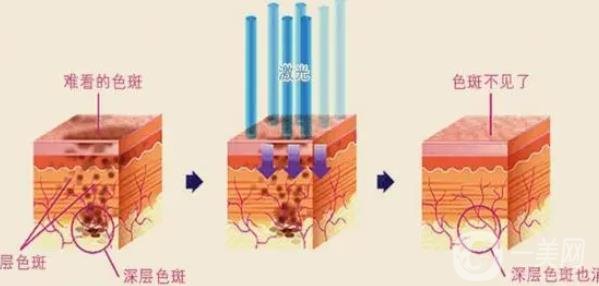 手术祛痣价格