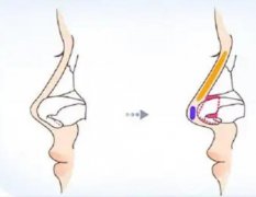 鼻小柱延长后会不会塌陷？哪些人群适合鼻小柱延长术？