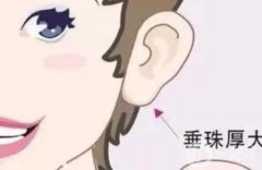 丰耳垂的方法有哪些？玻尿酸注射对丰耳垂有什么好处？