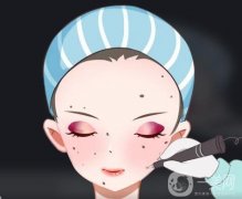 激光点痣后不能吃什么？可以吃辣椒吗？