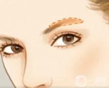 眉弓微整的优缺点？眉弓微整前有哪些准备？