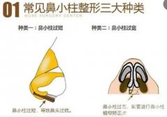 什么材料可以延长鼻小柱？有哪些手术方法？