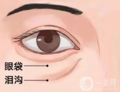 什么是泪沟？什么方法去除泪沟好？