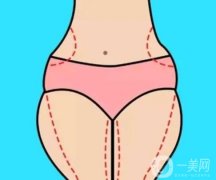 吸脂后小腿不平怎么办？术后凹凸不平能修复吗？