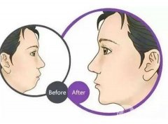 垫下巴有哪些优势？什么样的下巴手术受欢迎？