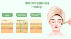 果酸换肤有哪些术前准备？术后如何护理？