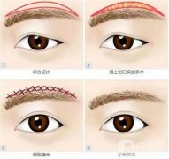 切眉术后面部怎么会有瘀伤？切眉后恢复自然要多久？