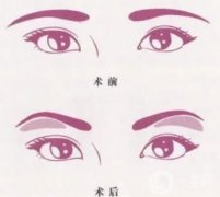 切眉手术后是不是衰老很快？