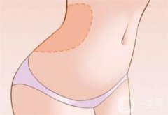 冷冻溶脂有吗？适合腰腹减肥吗？