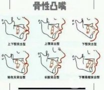骨性嘴凸有必要做正颌手术吗？骨性嘴凸矫正多少钱？