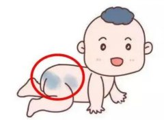 怎么避免激光去除胎记的复发？