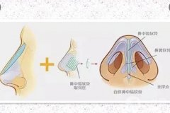 玻尿酸可以注射矫正鼻小柱吗？鼻小柱在哪里？