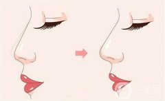 有多久的恢复期？如何护理？