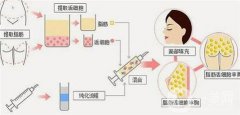 面部填充脂肪后多久能用洗面奶？多久能用护肤品？