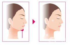 有哪些垫下巴的方式？垫下巴后怎么护理？