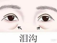 填充泪沟吗?有风险吗?什么会影响价格