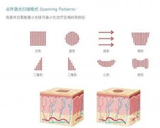 哪些情况可以做点阵激光？