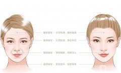 射频紧肤有没有果？适合什么人？