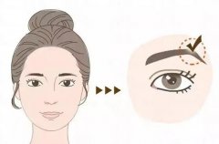 切眉有副作用吗？很容易感染吗