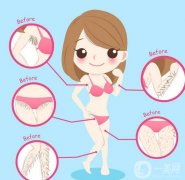 激光脱毛多少钱？禁忌人群分别有哪些？