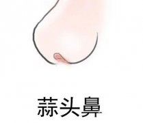 怎么矫正大蒜鼻？如何不手术改良大蒜鼻？