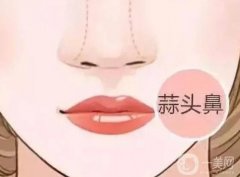 大蒜鼻整形有后遗症吗？恢复自然需要多长时间？