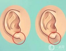 丰耳垂的方法有哪些？